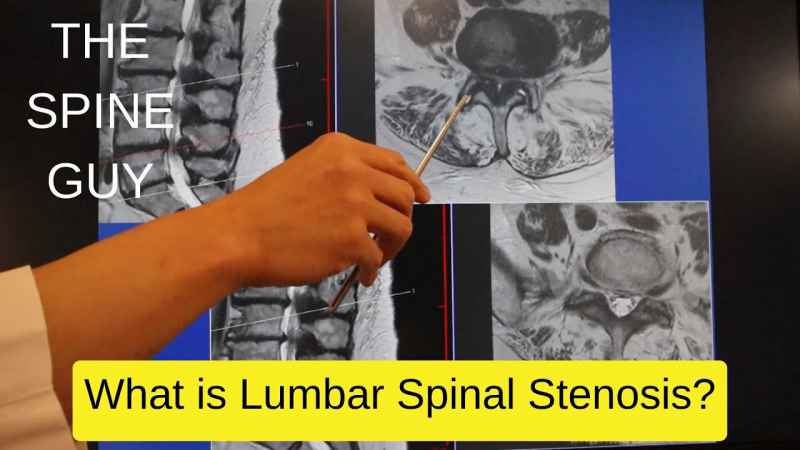 Living with Spinal Stenosis